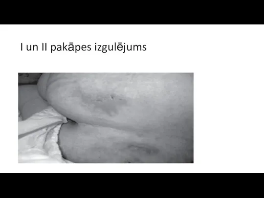 I un II pakāpes izgulējums