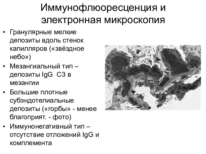 Иммунофлюоресценция и электронная микроскопия Гранулярные мелкие депозиты вдоль стенок капилляров