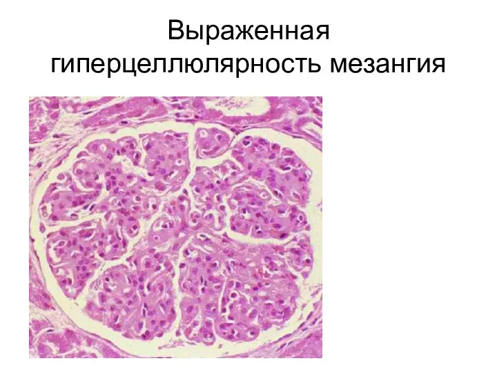 Выраженная гиперцеллюлярность мезангия