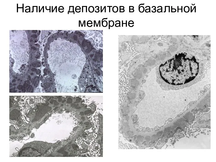 Наличие депозитов в базальной мембране