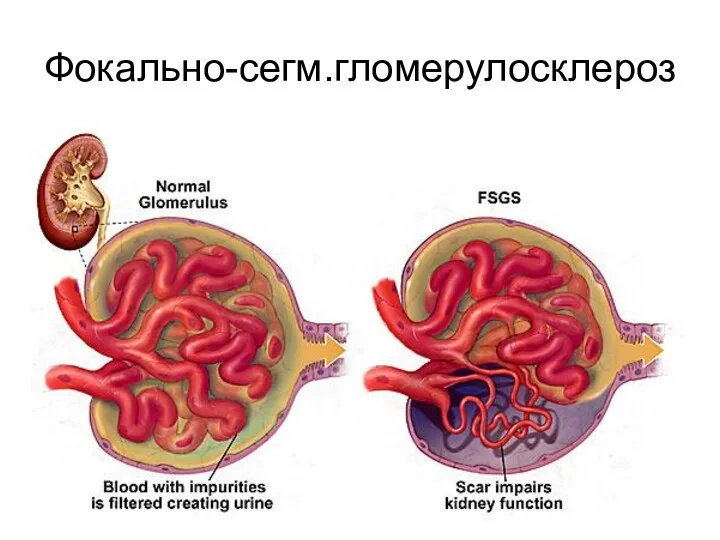 Фокально-сегм.гломерулосклероз