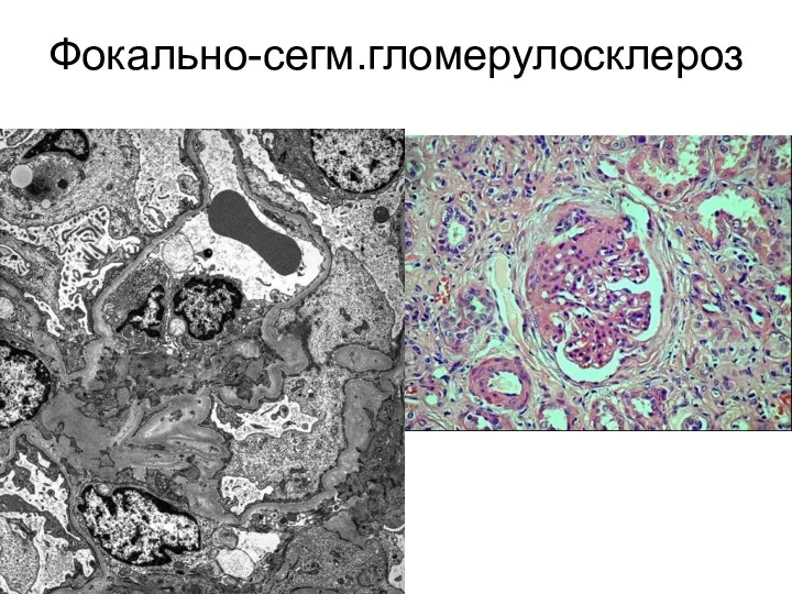 Фокально-сегм.гломерулосклероз