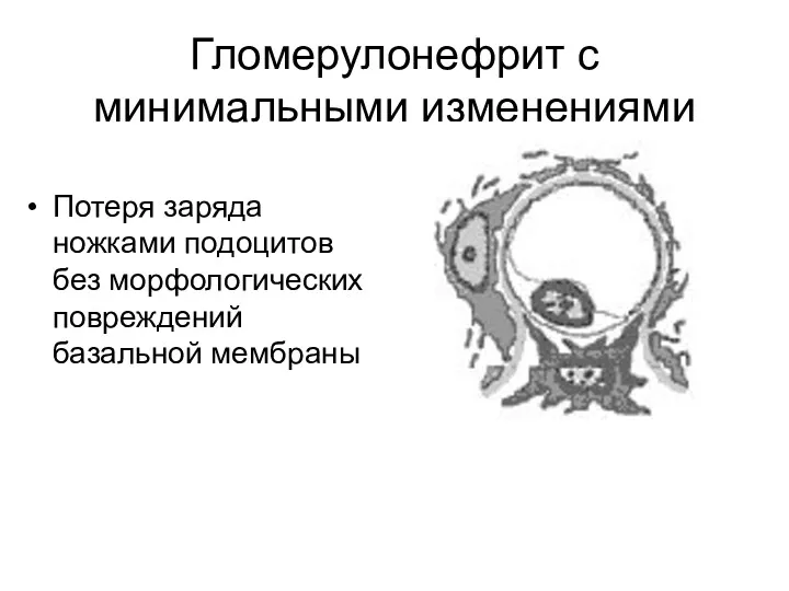 Гломерулонефрит с минимальными изменениями Потеря заряда ножками подоцитов без морфологических повреждений базальной мембраны