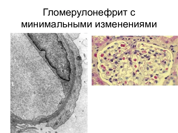 Гломерулонефрит с минимальными изменениями