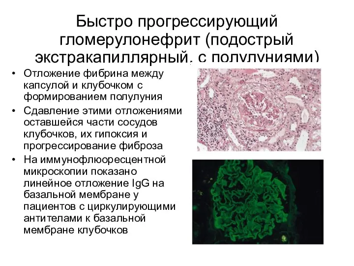 Быстро прогрессирующий гломерулонефрит (подострый экстракапиллярный, с полулуниями) Отложение фибрина между