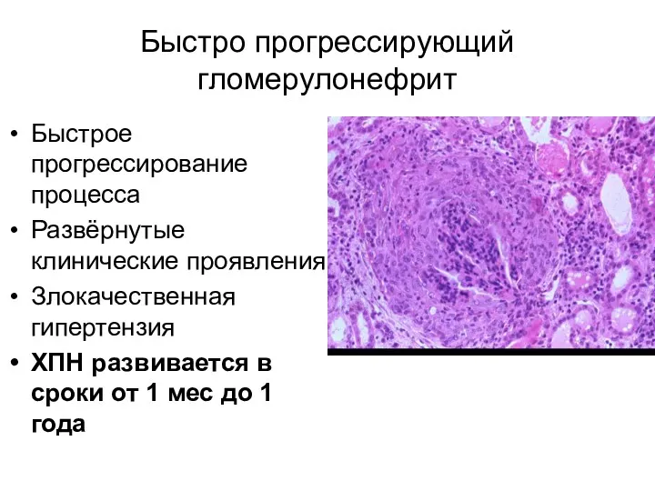 Быстро прогрессирующий гломерулонефрит Быстрое прогрессирование процесса Развёрнутые клинические проявления Злокачественная