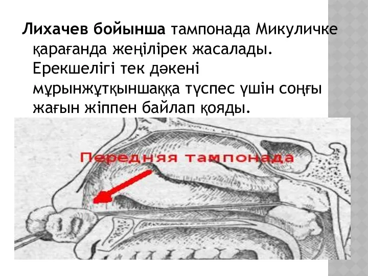 Лихачев бойынша тампонада Микуличке қарағанда жеңілірек жасалады. Ерекшелігі тек дәкені мұрынжұтқыншаққа түспес үшін