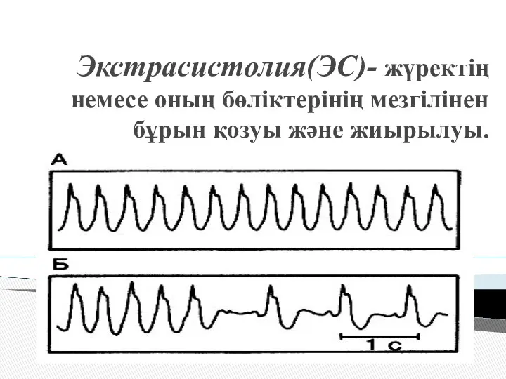 Экстрасистолия(ЭС)- жүректің немесе оның бөліктерінің мезгілінен бұрын қозуы және жиырылуы.