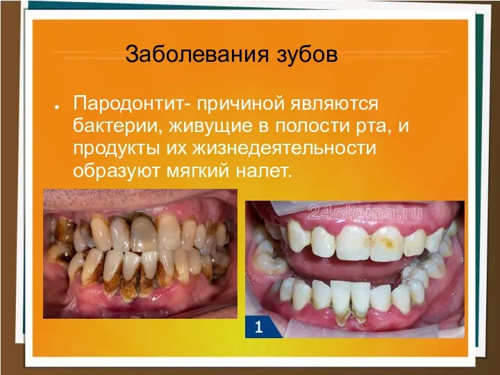 Заболевания зубов Пародонтит- причиной являются бактерии, живущие в полости рта, и продукты их