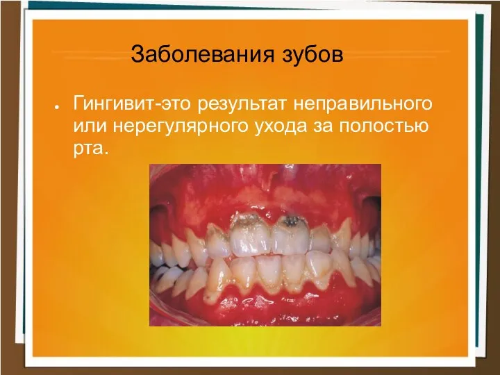 Заболевания зубов Гингивит-это результат неправильного или нерегулярного ухода за полостью рта.