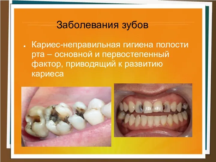 Заболевания зубов Кариес-неправильная гигиена полости рта – основной и первостепенный фактор, приводящий к развитию кариеса