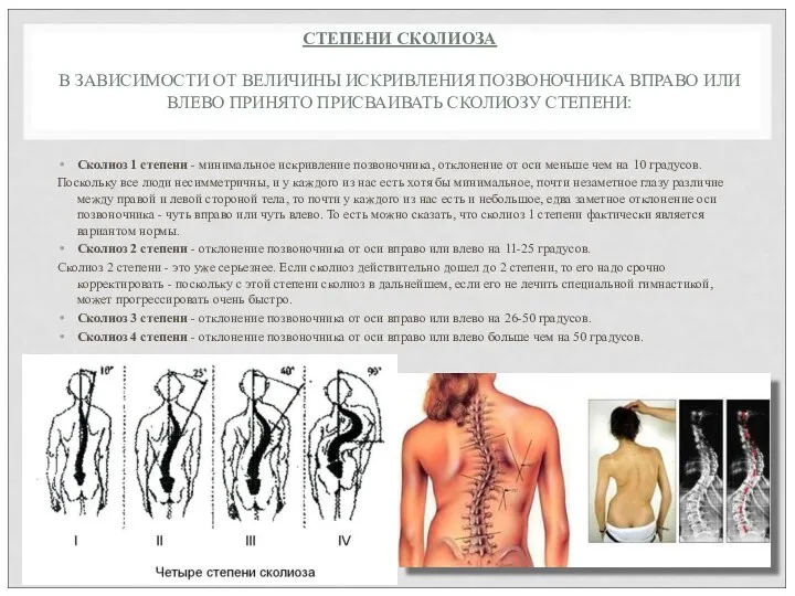 СТЕПЕНИ СКОЛИОЗА В ЗАВИСИМОСТИ ОТ ВЕЛИЧИНЫ ИСКРИВЛЕНИЯ ПОЗВОНОЧНИКА ВПРАВО ИЛИ