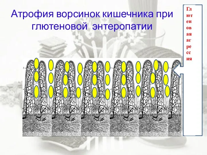 г Глютеновая агрессия Атрофия ворсинок кишечника при глютеновой энтеропатии