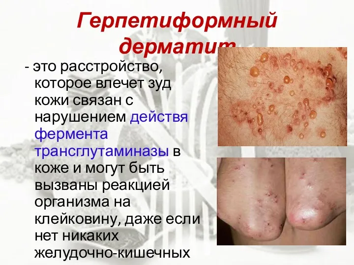 Герпетиформный дерматит - это расстройство, которое влечет зуд кожи связан