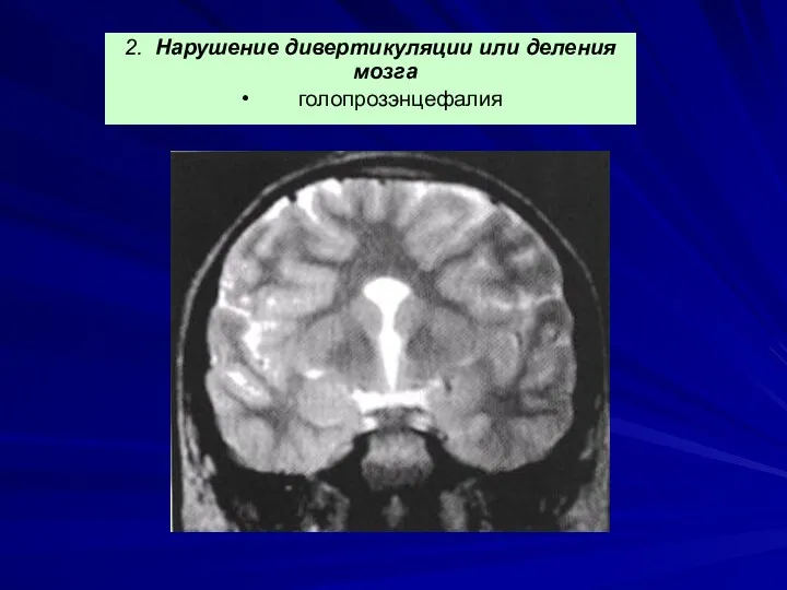 2. Нарушение дивертикуляции или деления мозга голопрозэнцефалия
