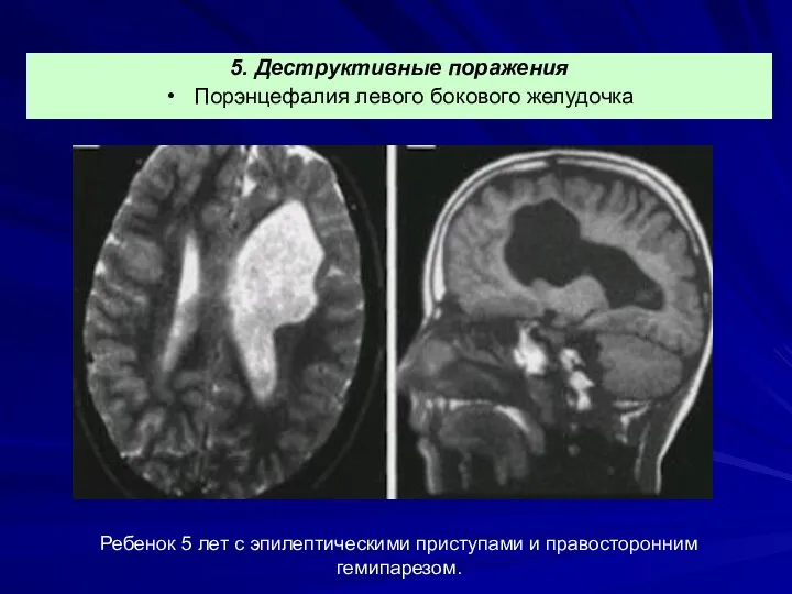 Ребенок 5 лет с эпилептическими приступами и правосторонним гемипарезом. 5. Деструктивные поражения Порэнцефалия левого бокового желудочка