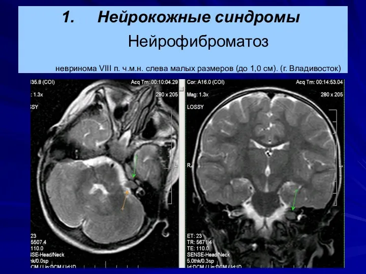 Нейрокожные синдромы Нейрофиброматоз невринома VIII п. ч.м.н. слева малых размеров (до 1,0 см). (г. Владивосток)