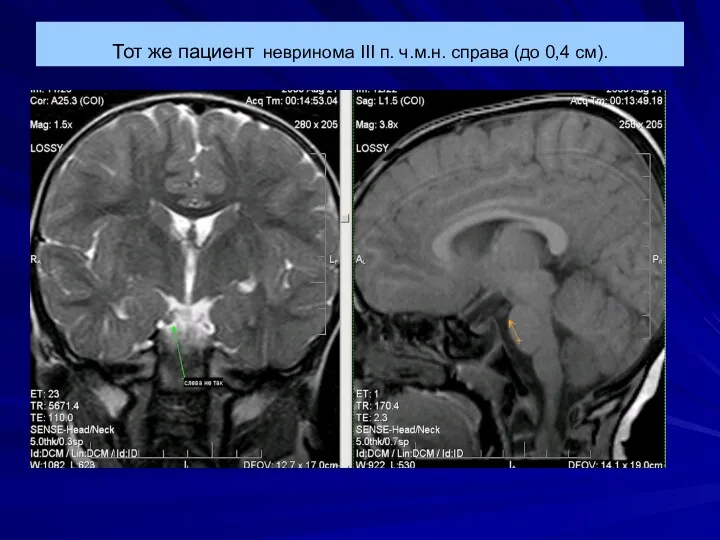 Тот же пациент невринома III п. ч.м.н. справа (до 0,4 см).