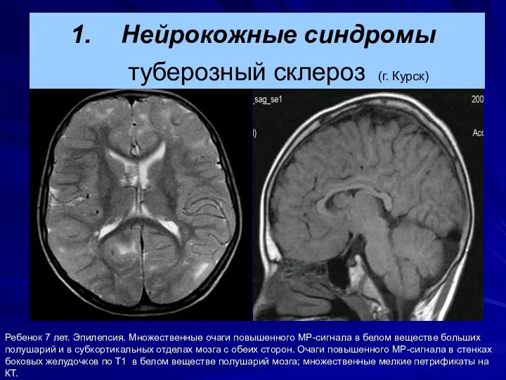 Ребенок 7 лет. Эпилепсия. Множественные очаги повышенного МР-сигнала в белом веществе больших полушарий