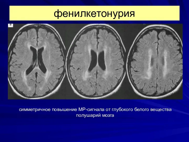 фенилкетонурия симметричное повышение МР-сигнала от глубокого белого вещества полушарий мозга