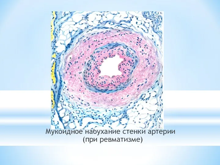 Мукоидное набухание стенки артерии (при ревматизме)