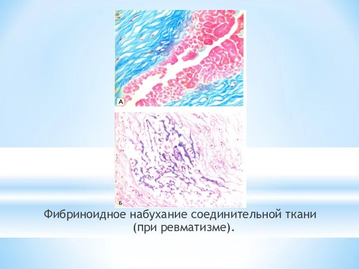 Фибриноидное набухание соединительной ткани (при ревматизме).