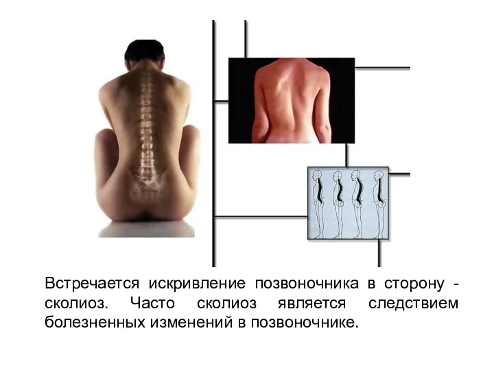 Встречается искривление позвоночника в сторону - сколиоз. Часто сколиоз является следствием болезненных изменений в позвоночнике.