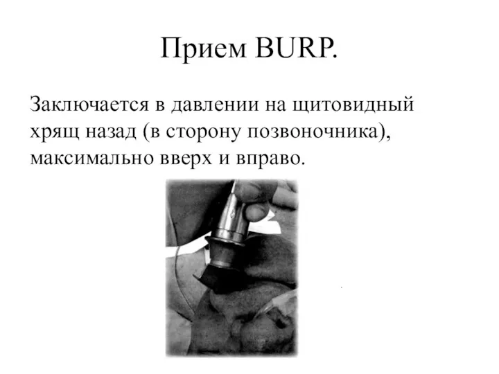Прием BURP. Заключается в давлении на щитовидный хрящ назад (в сторону позвоночника), максимально вверх и вправо.