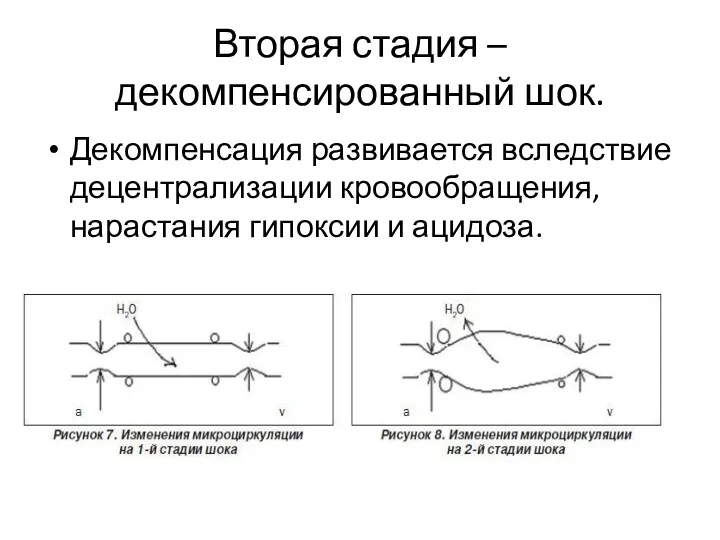 Вторая стадия – декомпенсированный шок. Декомпенсация развивается вследствие децентрализации кровообращения, нарастания гипоксии и ацидоза.