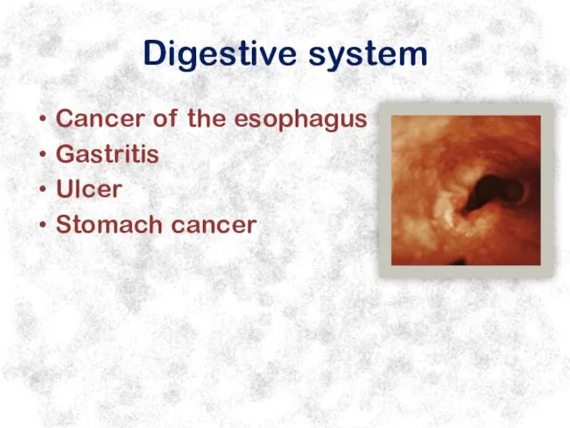 Digestive system Cancer of the esophagus Gastritis Ulcer Stomach cancer