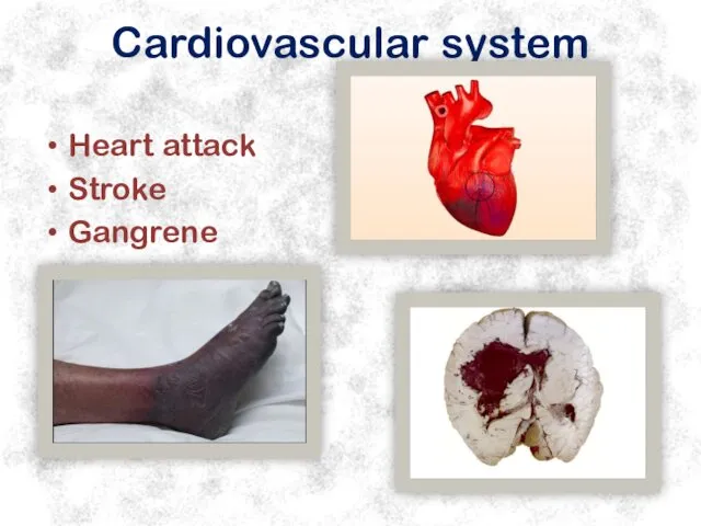 Cardiovascular system Heart attack Stroke Gangrene