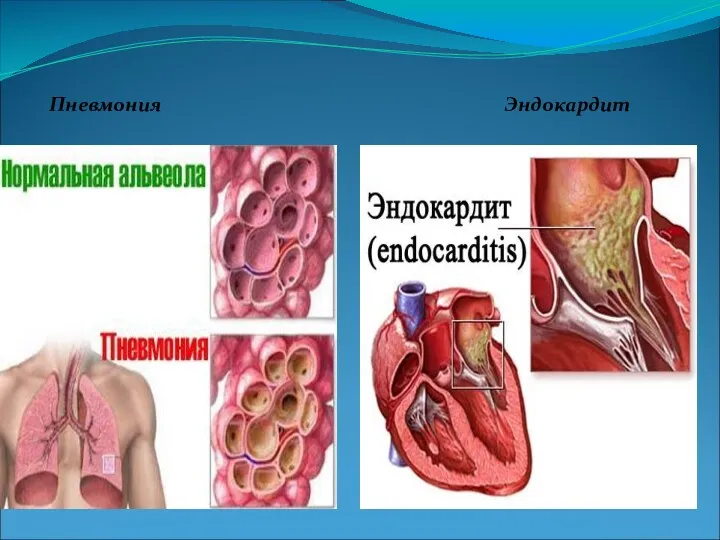 Пневмония Эндокардит