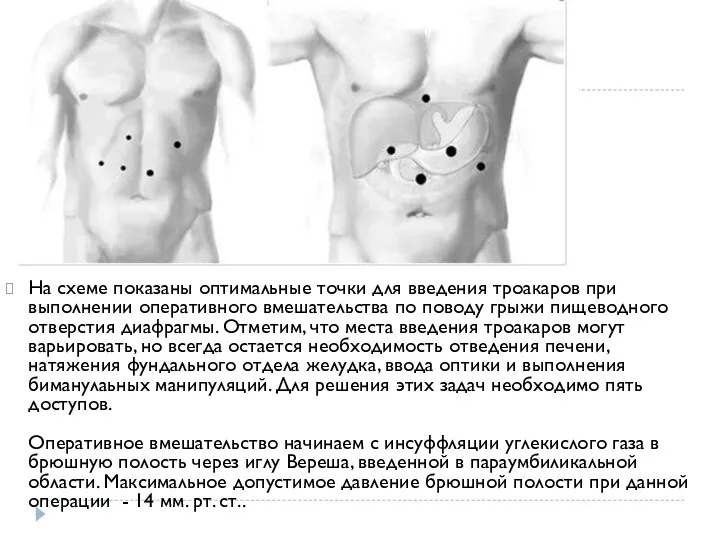 На схеме показаны оптимальные точки для введения троакаров при выполнении