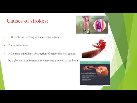 Causes of strokes: 1. thrombosis: clotting of the cerebral arteries 2.arterial rupture 3.Cerebral