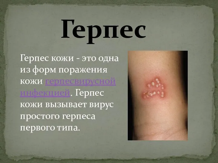 Герпес Герпес кожи - это одна из форм поражения кожи