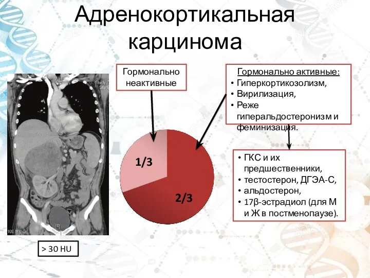 Адренокортикальная карцинома Гормонально неактивные Гормонально активные: Гиперкортикозолизм, Вирилизация, Реже гиперальдостеронизм