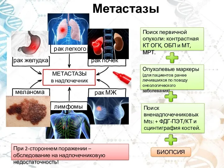 Метастазы рак легкого рак желудка рак МЖ рак почек меланома