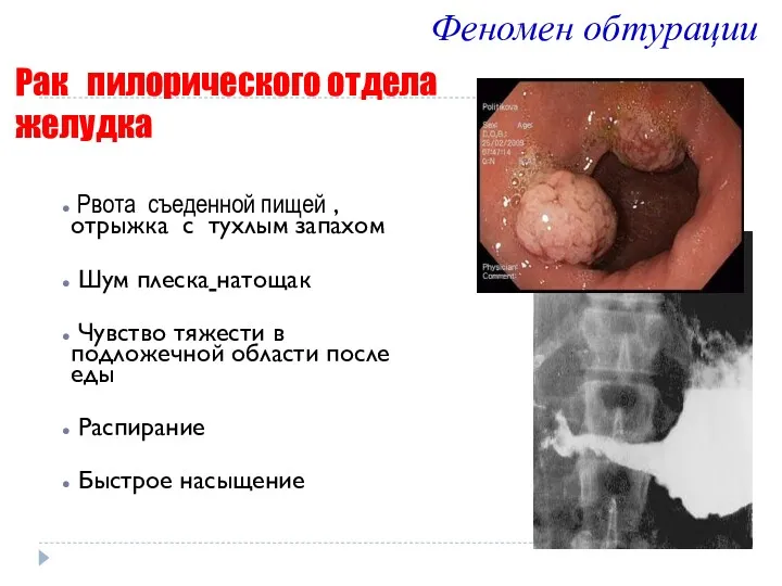 Рак пилорического отдела желудка Рвота съеденной пищей , отрыжка с