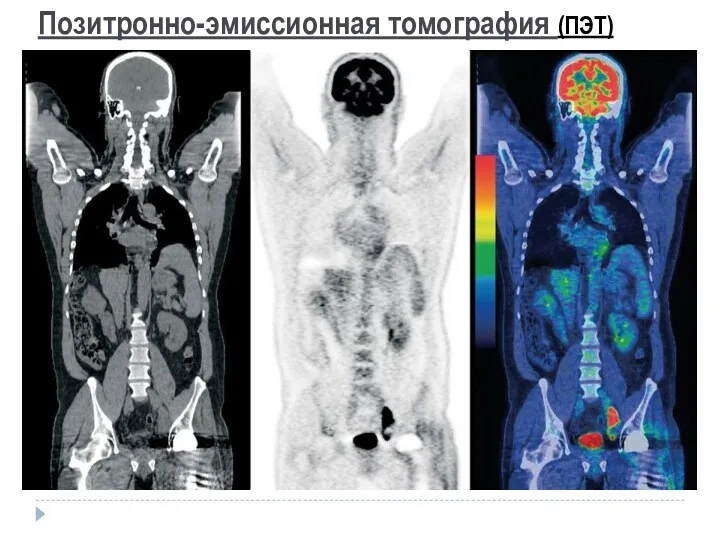 Позитронно-эмиссионная томография (ПЭТ)