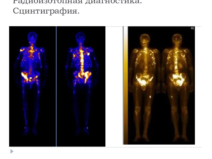 Радиоизотопная диагностика. Сцинтиграфия.