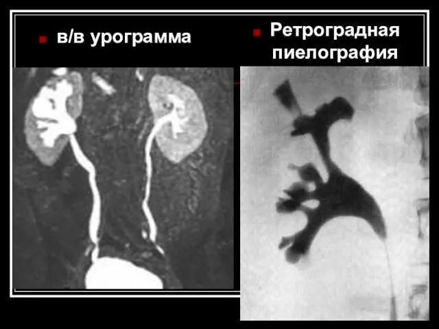 в/в урограмма Ретроградная пиелография