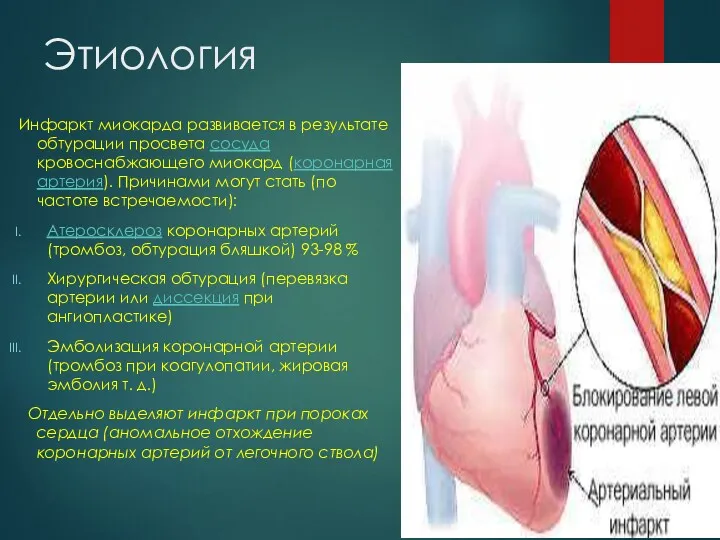 Этиология Инфаркт миокарда развивается в результате обтурации просвета сосуда кровоснабжающего миокард (коронарная артерия).