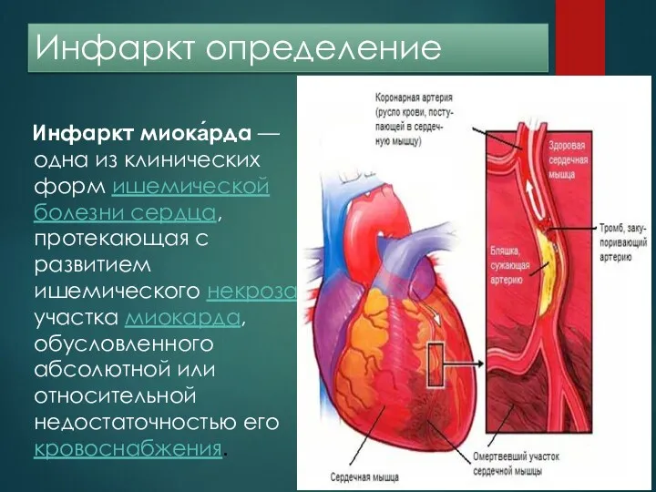 Инфаркт определение Инфаркт миока́рда — одна из клинических форм ишемической болезни сердца, протекающая