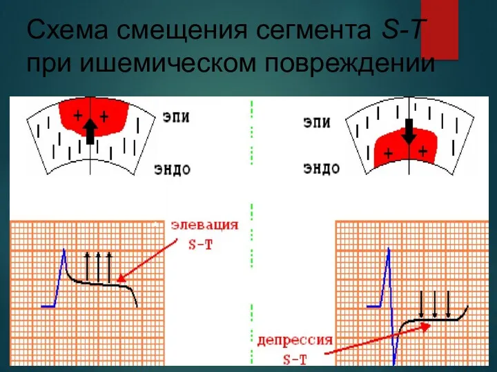 Схема смещения сегмента S-T при ишемическом повреждении