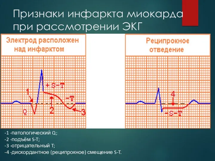 Признаки инфаркта миокарда при рассмотрении ЭКГ -1 -патологический Q; -2 -подъём S-T; -3