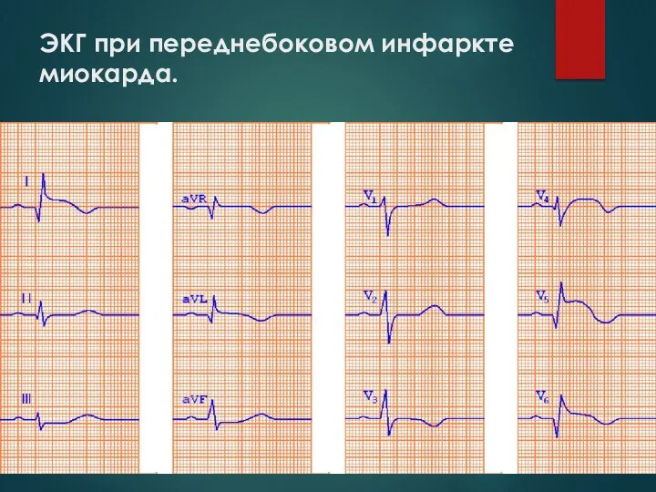 ЭКГ при переднебоковом инфаркте миокарда.