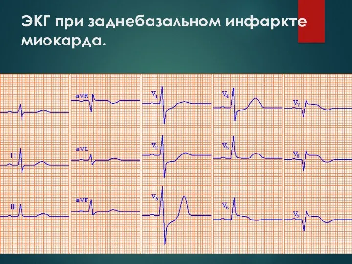 ЭКГ при заднебазальном инфаркте миокарда.