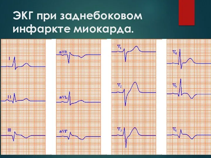 ЭКГ при заднебоковом инфаркте миокарда.