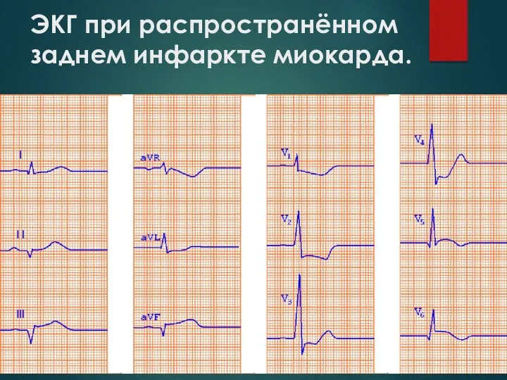 ЭКГ при распространённом заднем инфаркте миокарда.