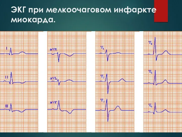 ЭКГ при мелкоочаговом инфаркте миокарда.
